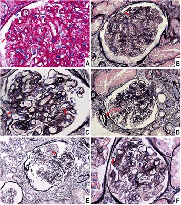 Case report: Nephrotic syndrome and portal hypertensive ascites after allogeneic hematopoietic stem cell transplantation: a rare manifestation of chronic graft-versus-host disease
